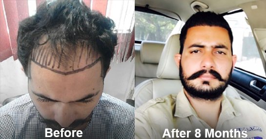 Hair Transplant Result