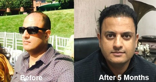 Hair Transplant Result