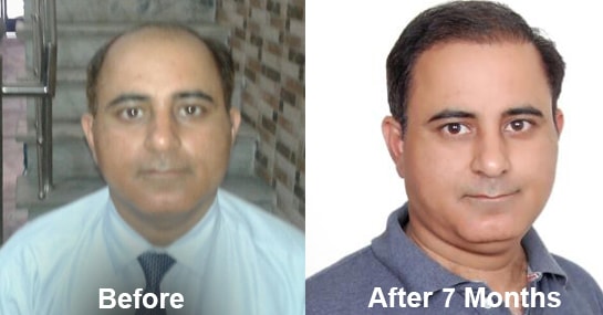 Hair Transplant Result