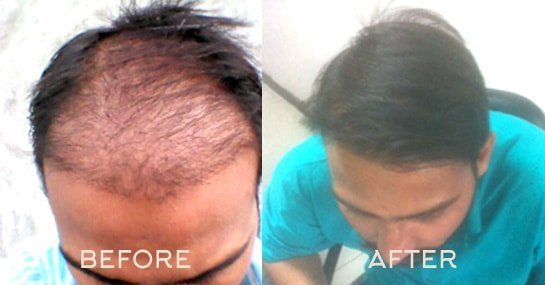 Hair Transplant Result