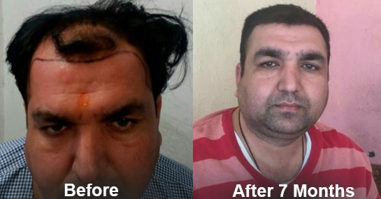 Hair Transplant Result