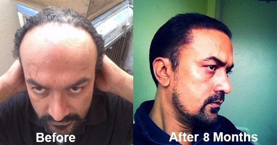 Hair Transplant Result