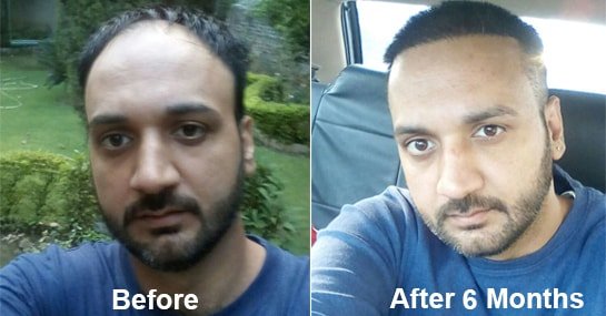 Hair Transplant Result