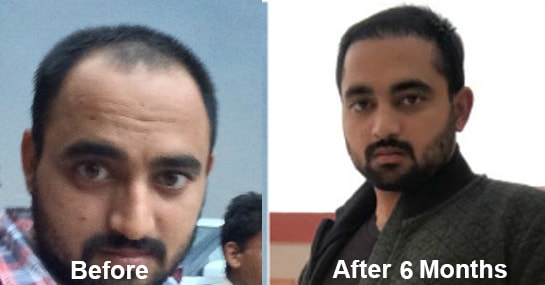 Hair Transplant Result