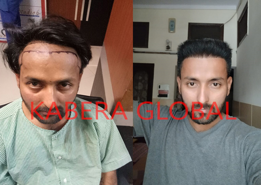 Hair Transplant Result