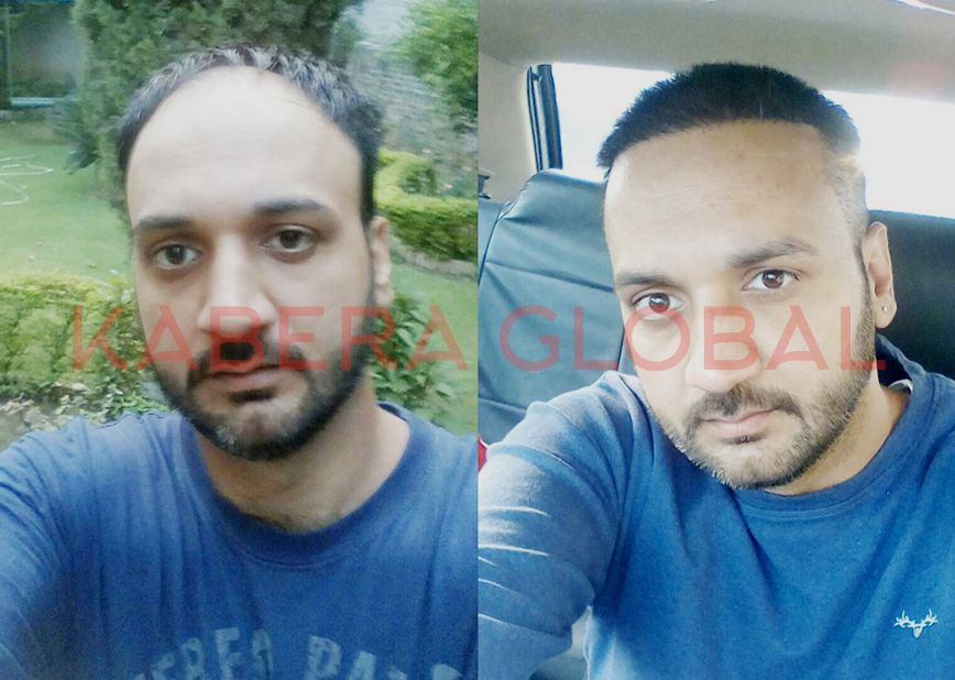 Hair Transplant Result