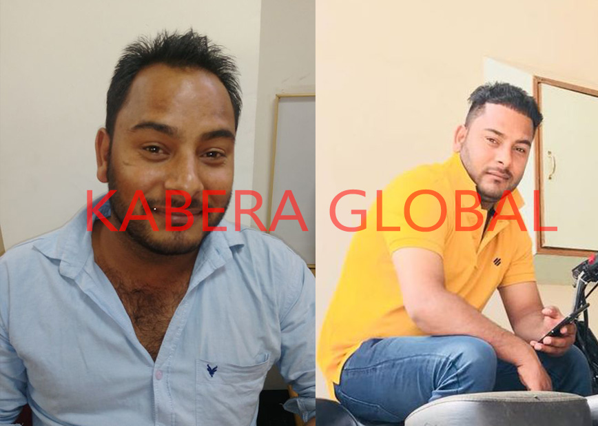 Hair Transplant Result