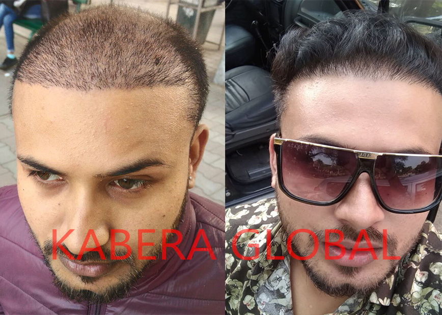 Hair Transplant Result