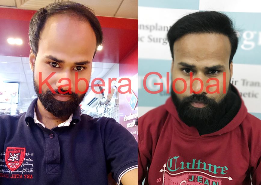 Hair Transplant Result