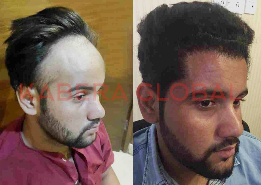 Hair Transplant Result