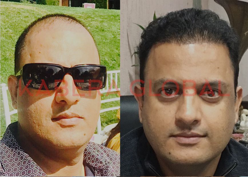 Hair Transplant Result