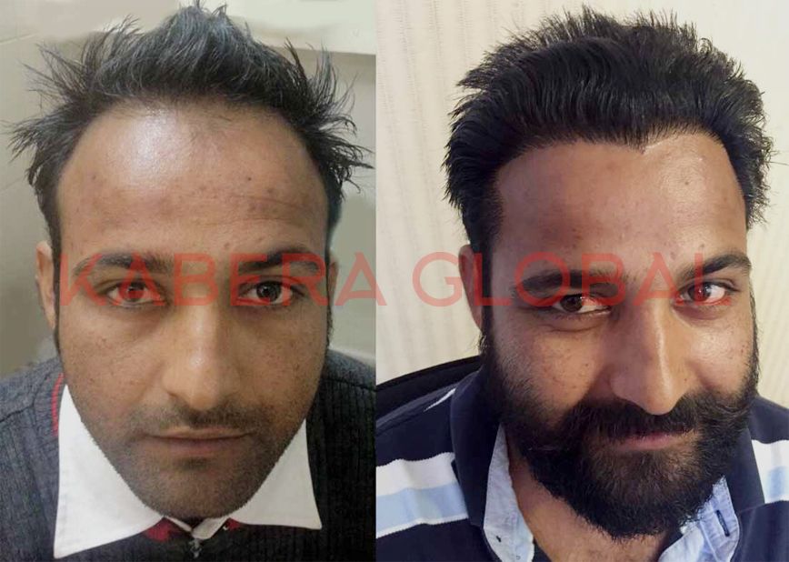 Hair Transplant Result